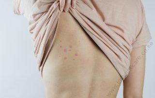bed-bug-control-1